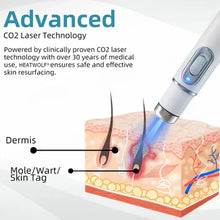 Load image into Gallery viewer, Bikenda® 🔥🔥 Non-Invasive Mole and Wart Removal Laser Pen