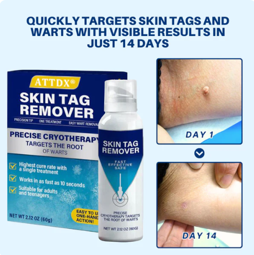 ATTDX® TagRecede Cryo Treatment Spray