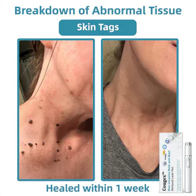 Bikenda® 🔥🔥 Non-Invasive Mole and Wart Removal Laser Pen